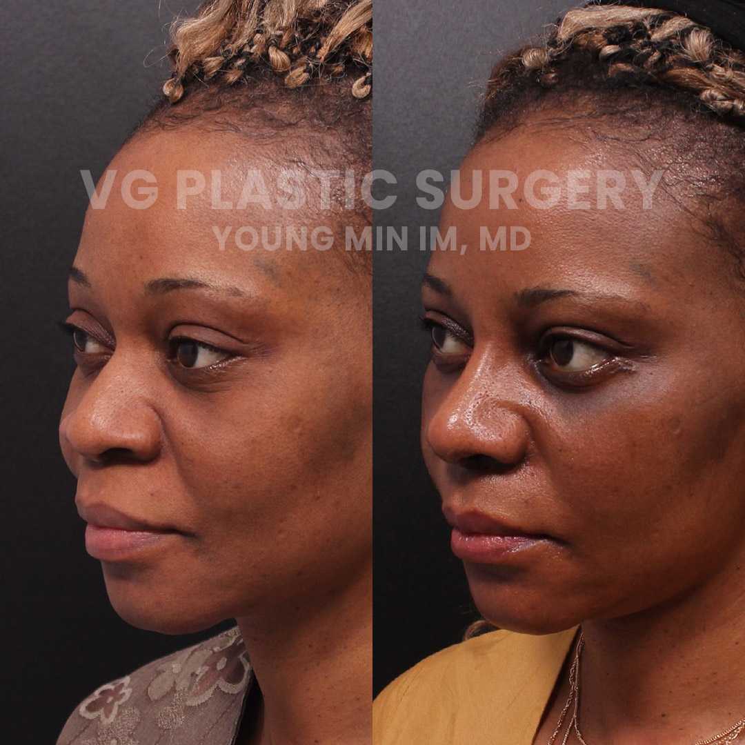 Rhinoplasty Package in Seoul South, Korea by VG Plastic Surgery