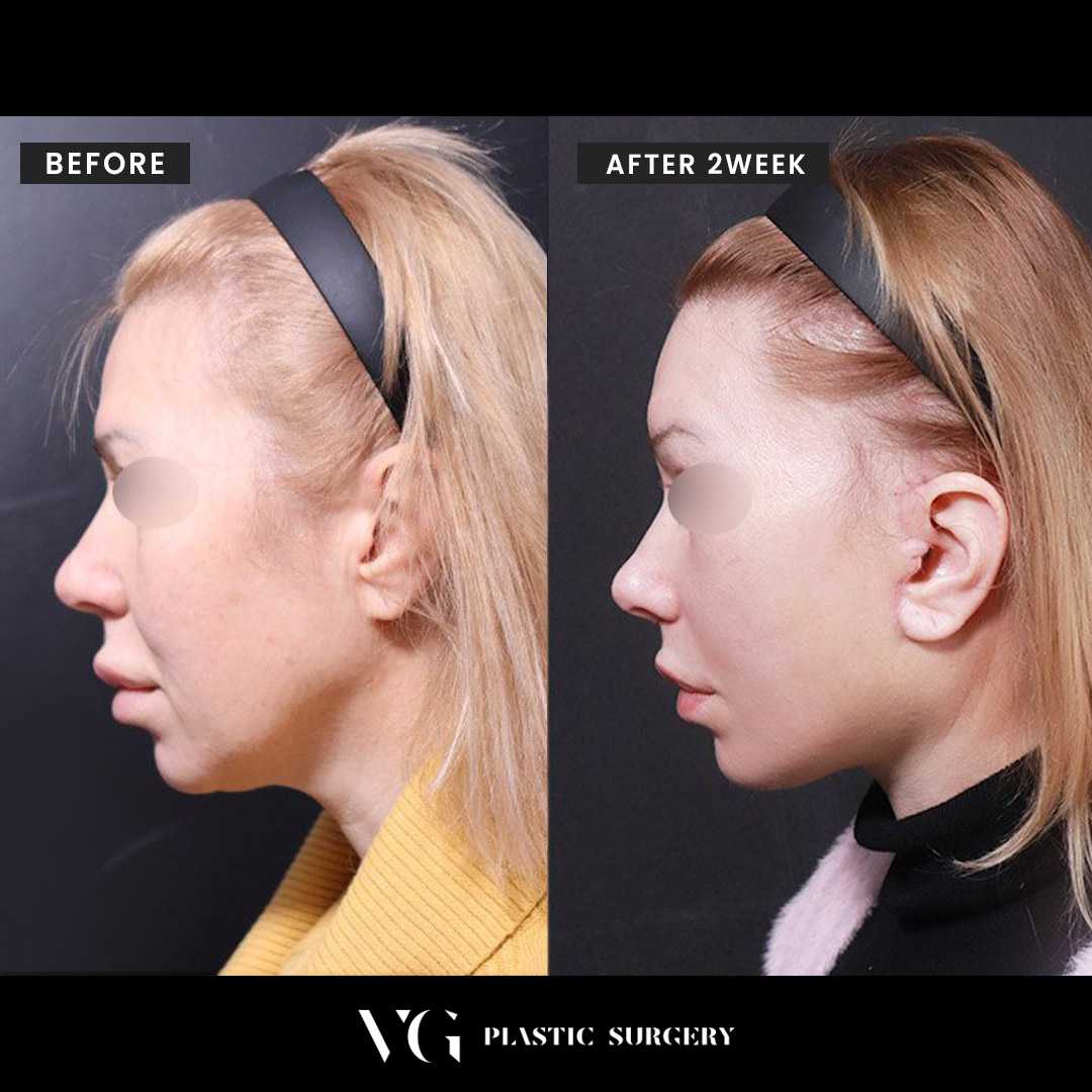 Neck Lift Package in Seoul, South Korea by VG Plastic Surgery