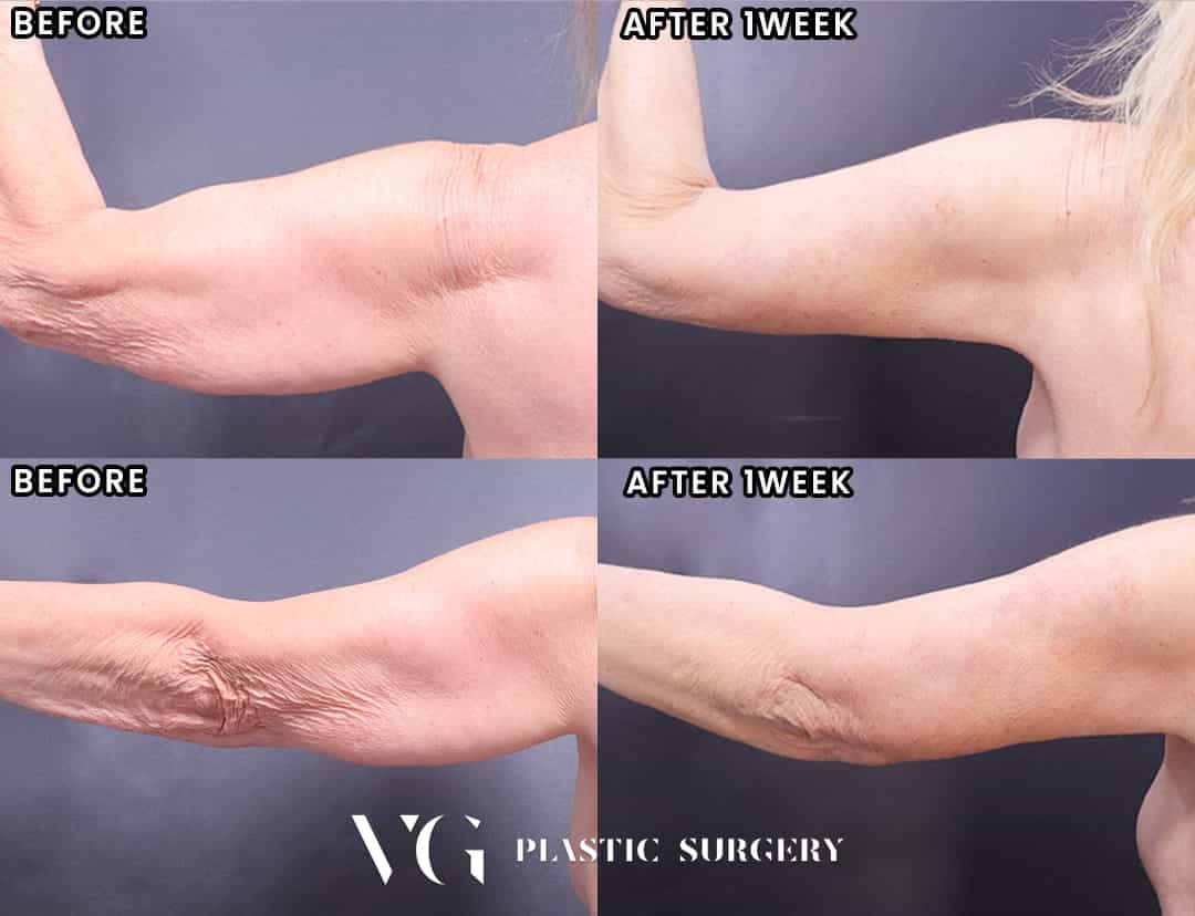Arm Lift Package at VG Plastic Surgery in Seoul, South Korea