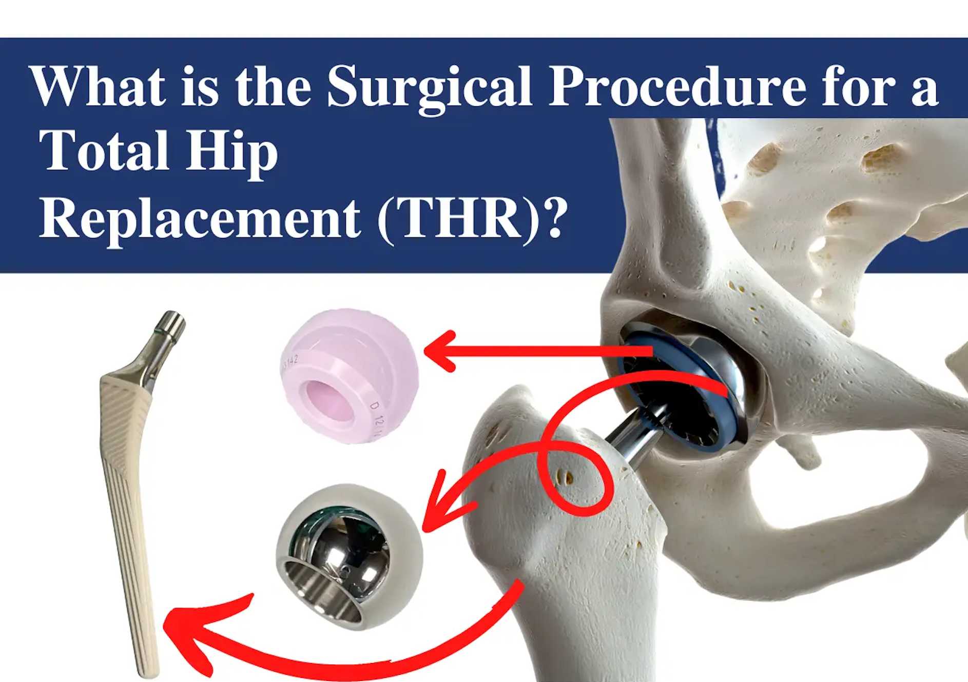 Total Hip Replacement (THR) Treatment Package