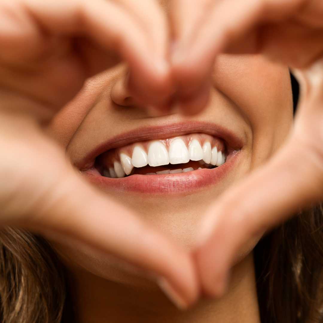 Veneer Smile Makeover 12 Units Los Algodones Baja California 