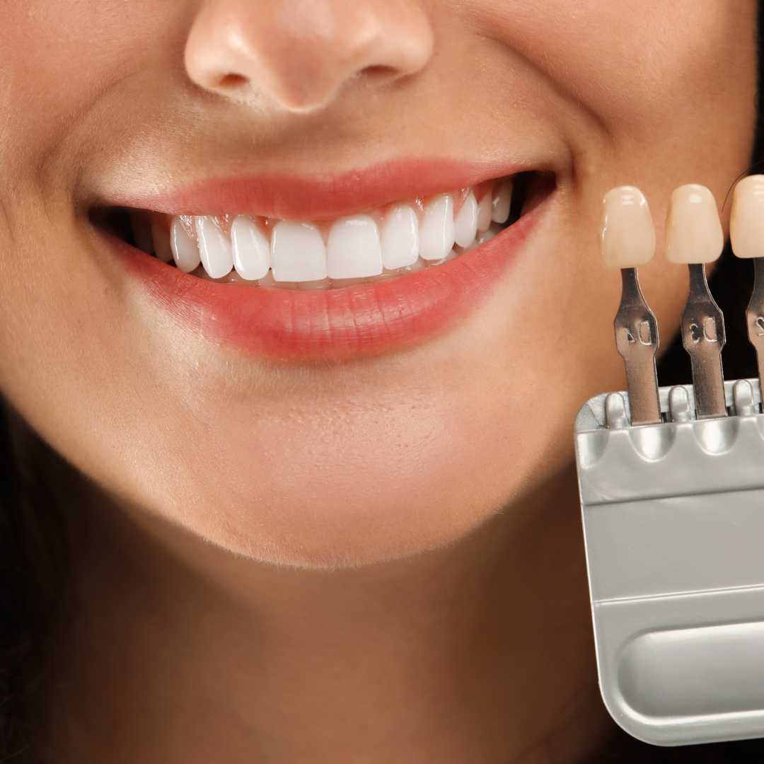 Smile makeover in Istanbul - Hollywood smile, implants, crowns in Istanbul