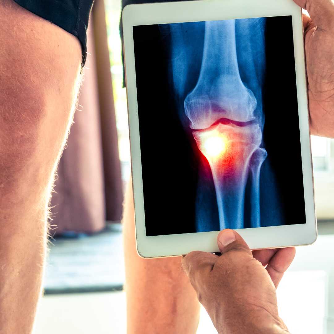 Stem Cell Treatment for Knee Osteoarthritis Abroad Package at Vega Stem Cell Clinic in Bangkok Thailand, Bangkok, Thailand