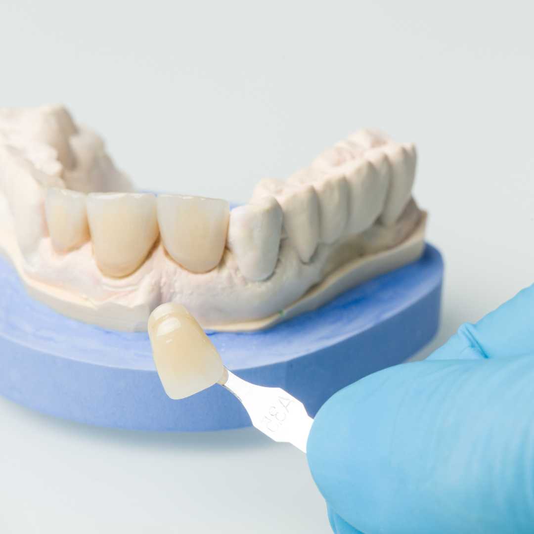 Cosmetic Crowns - Zirconia Package in Mexico