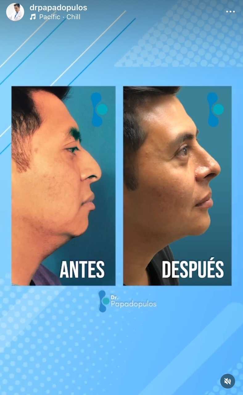 Nose Package at Dr. Ary Papadopulos - Plastic Surgery in Mexico City, Mexico City, Mexico