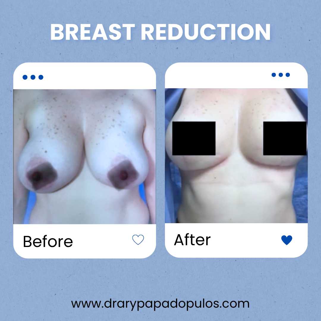 Breast Reduction Package at Dr. Ary Papadopulos - Plastic Surgery in Mexico City, Mexico City, Mexico