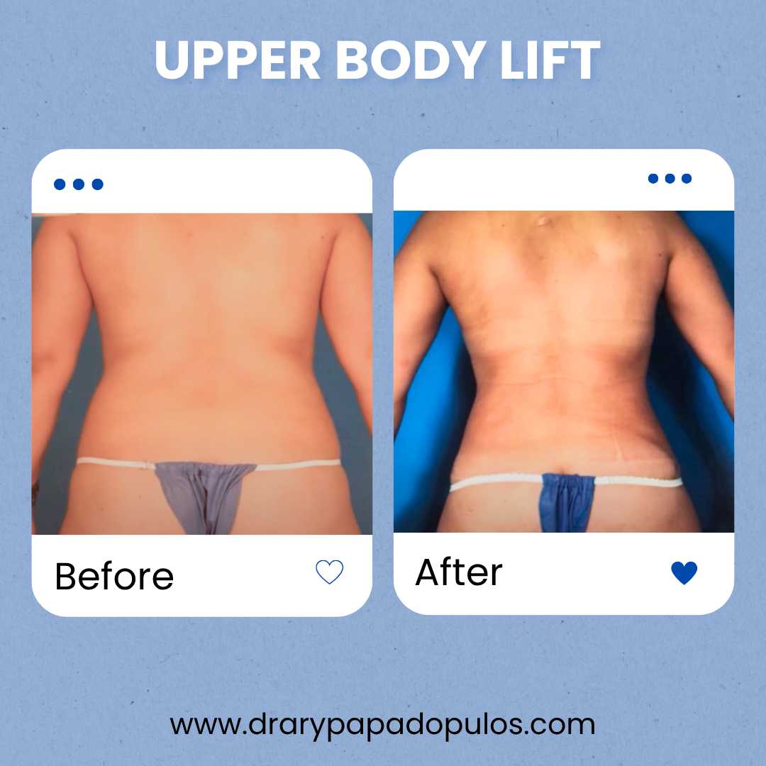 Upper body Lift Package at Dr. Ary Papadopulos - Plastic Surgery in Mexico City, Mexico City, Mexico