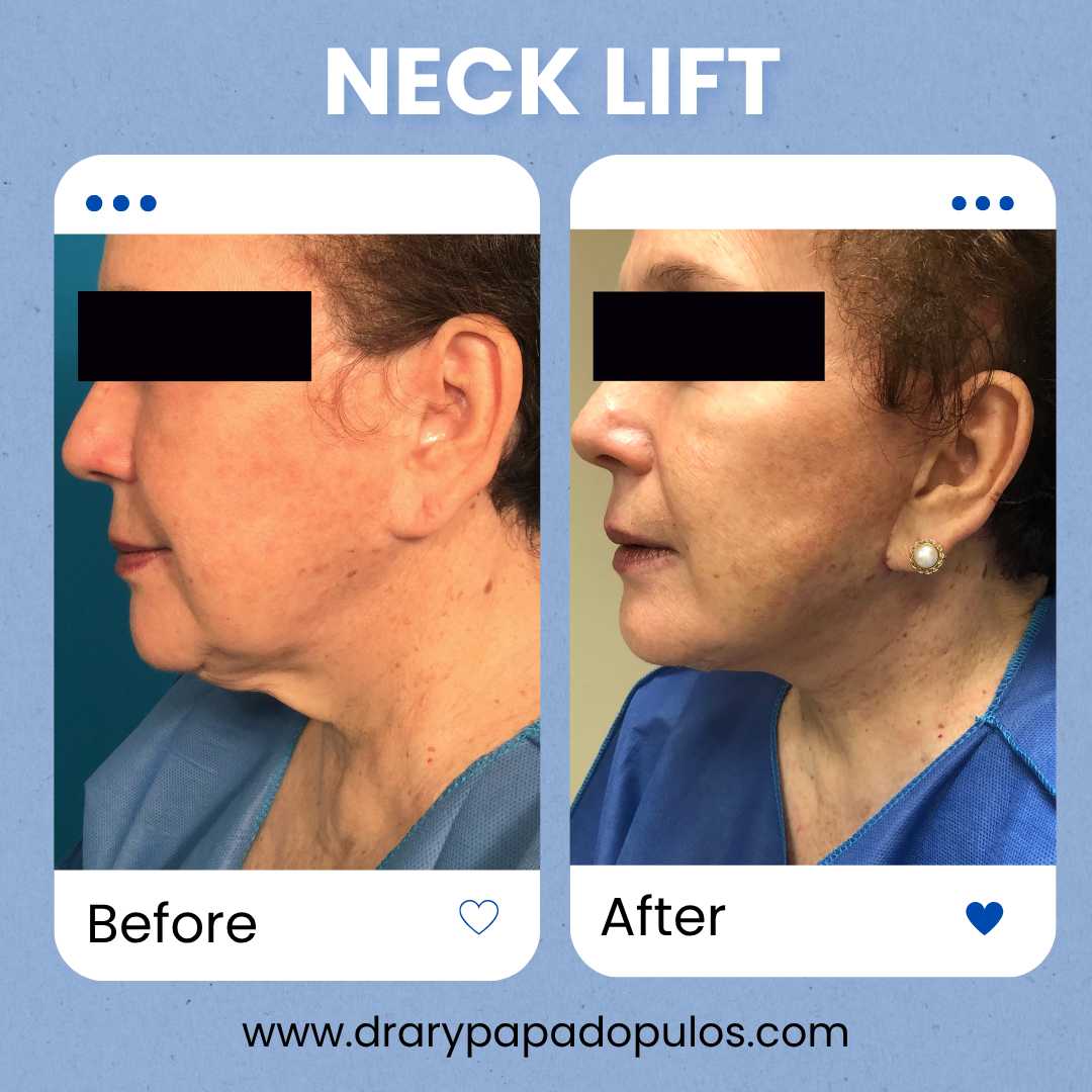 Neck Lift Package at Dr. Ary Papadopulos - Plastic Surgery in Mexico City, Mexico City, Mexico