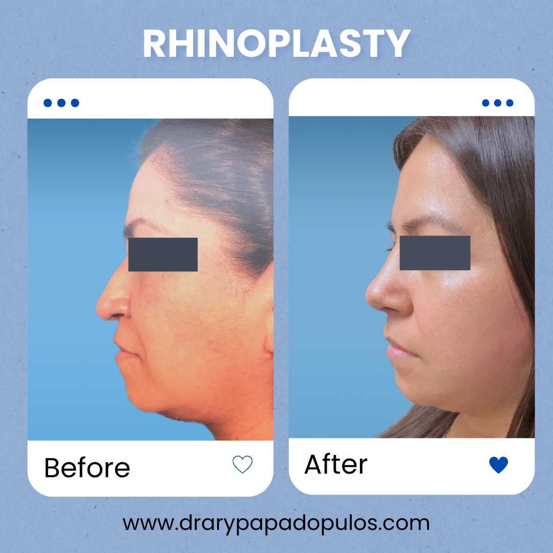 Nose Package at Dr. Ary Papadopulos - Plastic Surgery in Mexico City, Mexico City, Mexico