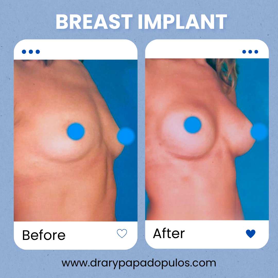 Breast Implants Package at Dr. Ary Papadopulos - Plastic Surgery in Mexico City, Mexico City, Mexico