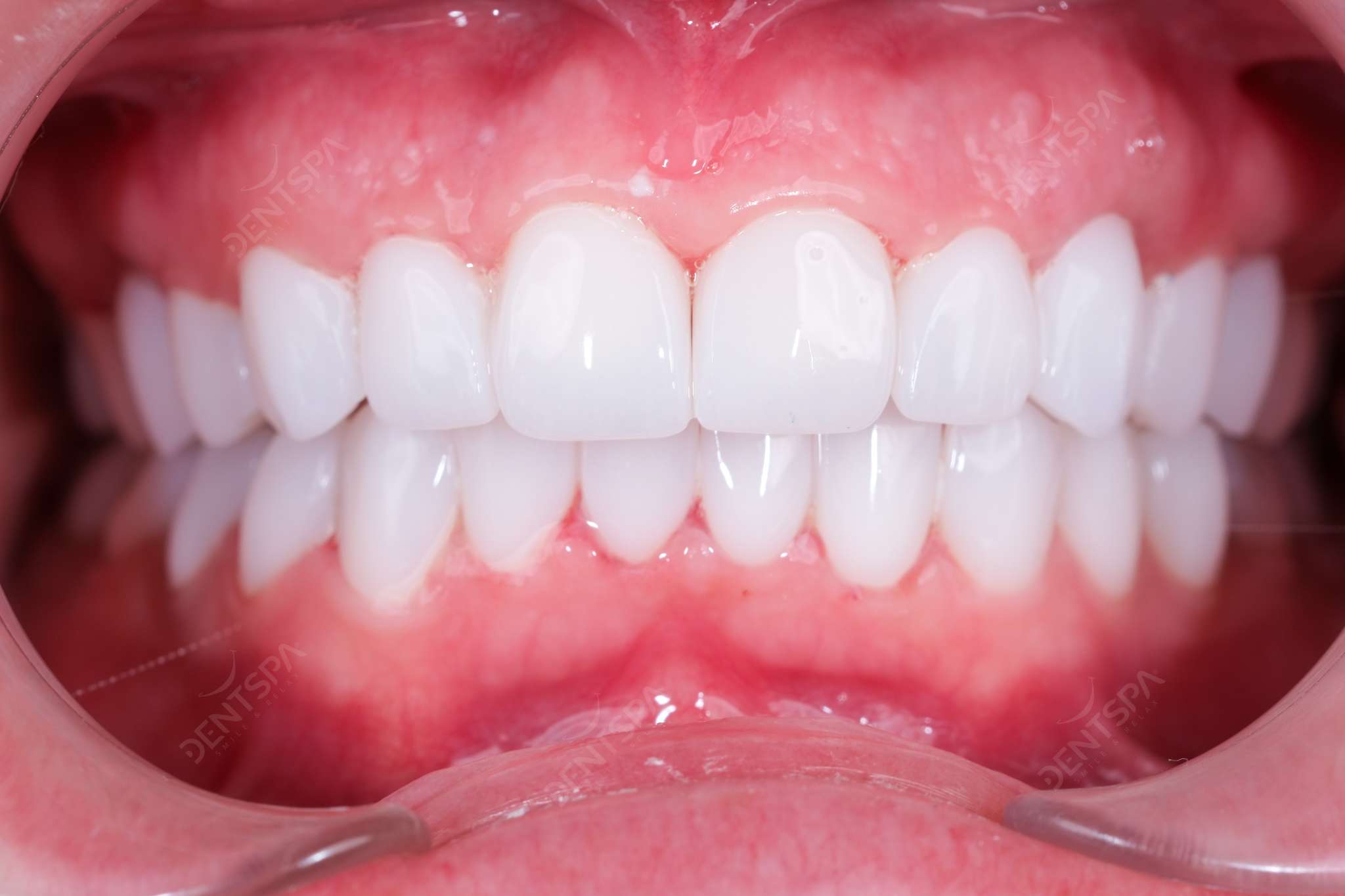 Full Mouth Implantation 
