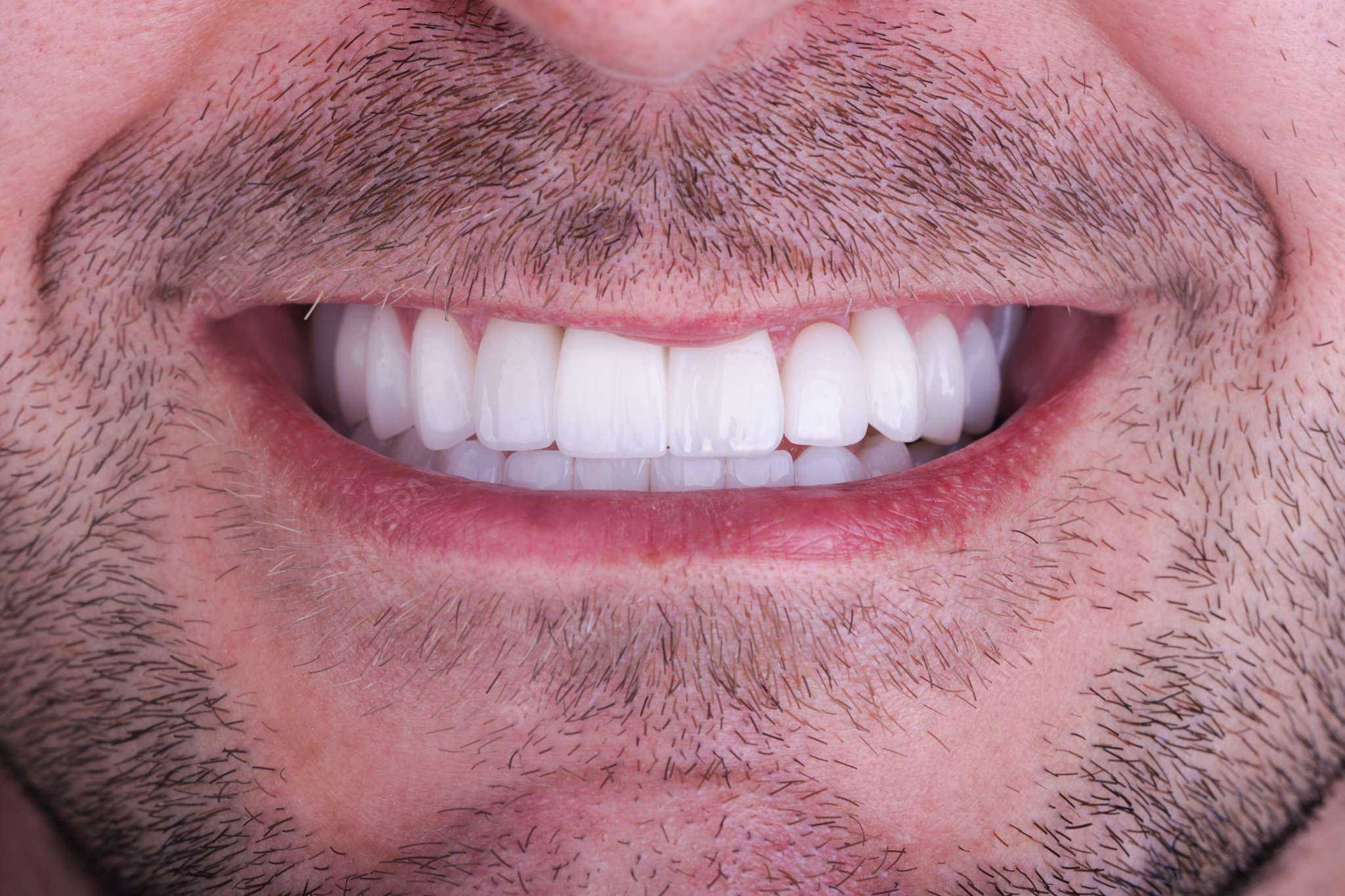 All on 4 Dental Implants Package at DentSpa