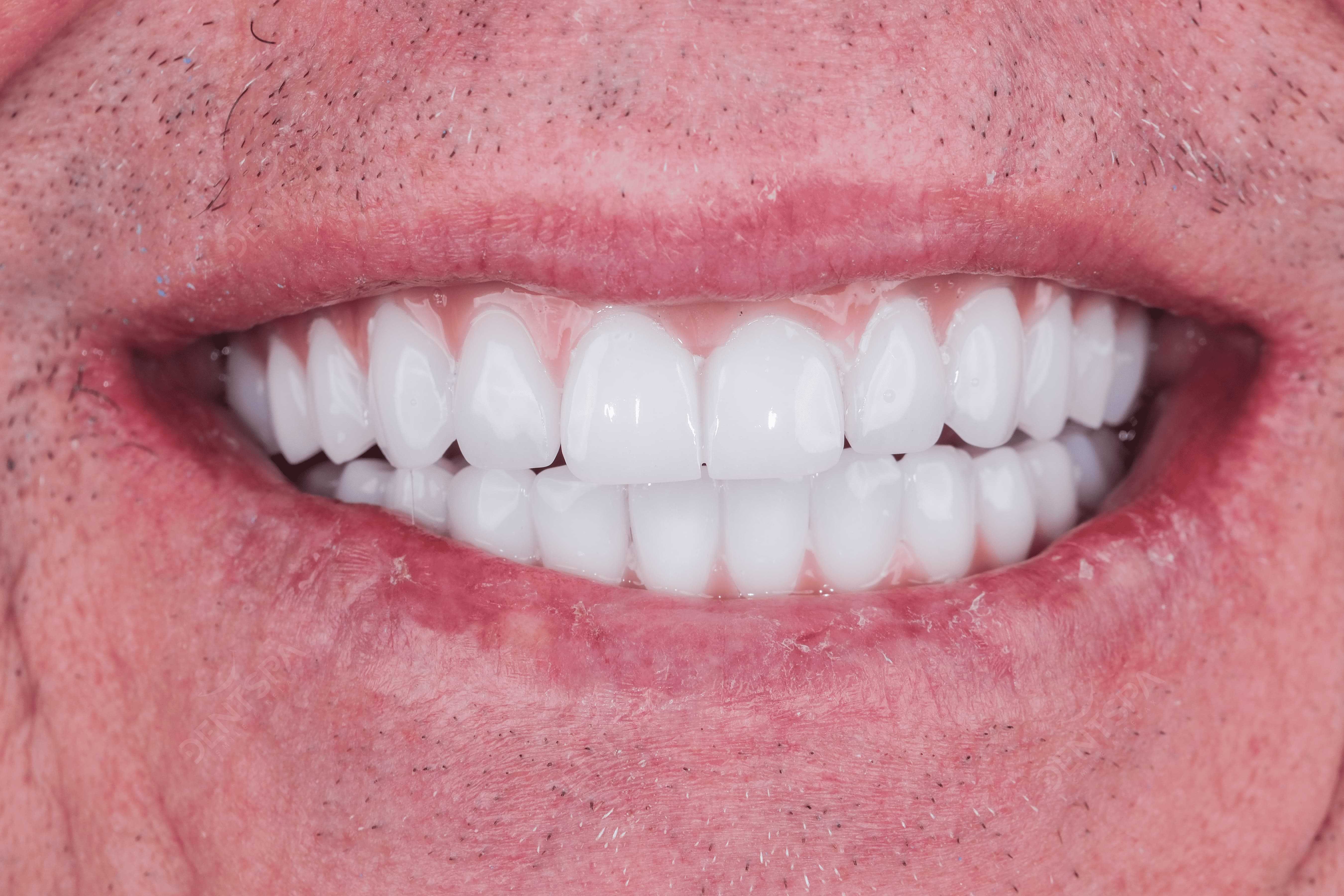 ALL-ON-6 DENTAL IMPLANTS + CROWNS 
