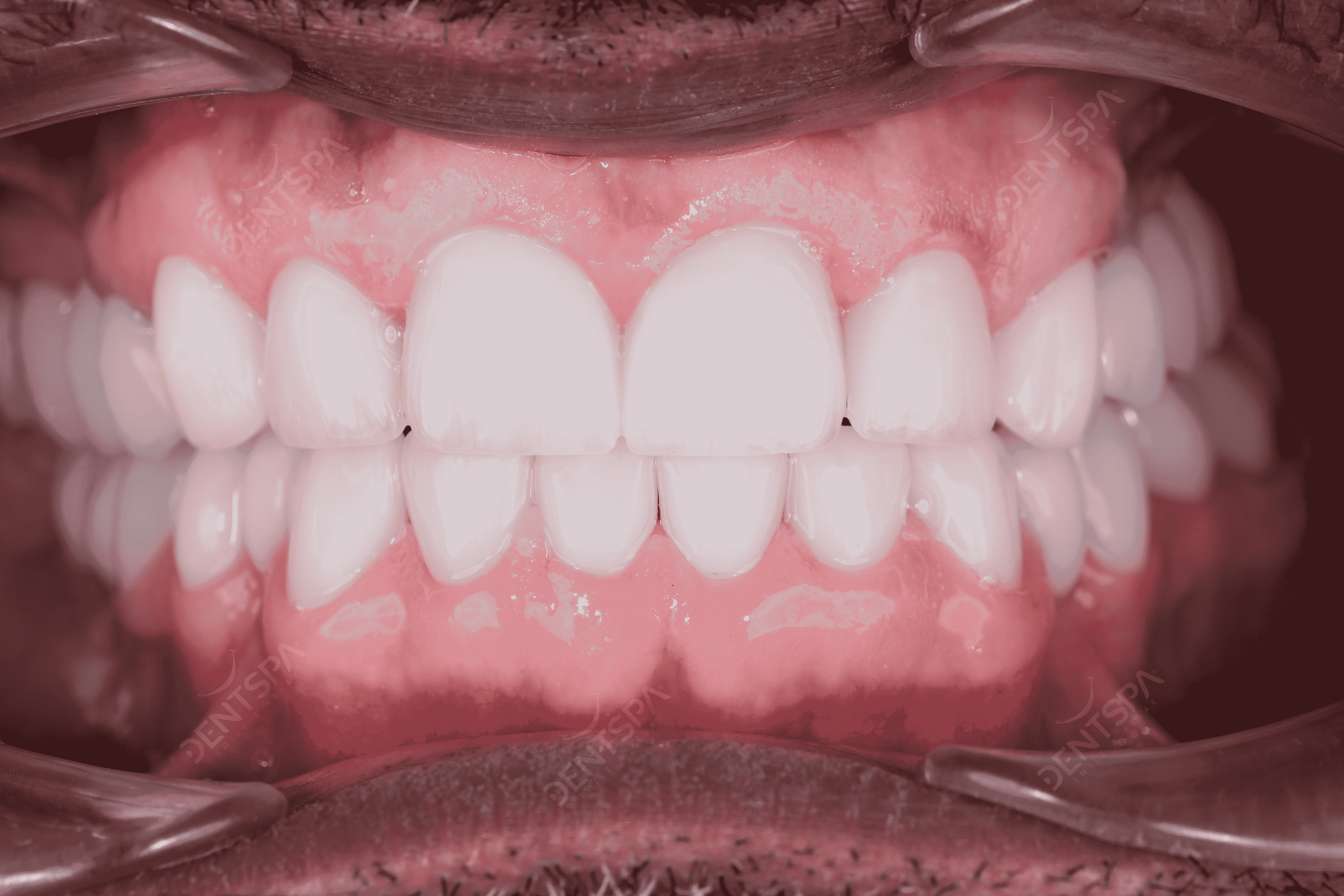 Hollywood Smile - E-max Veneers