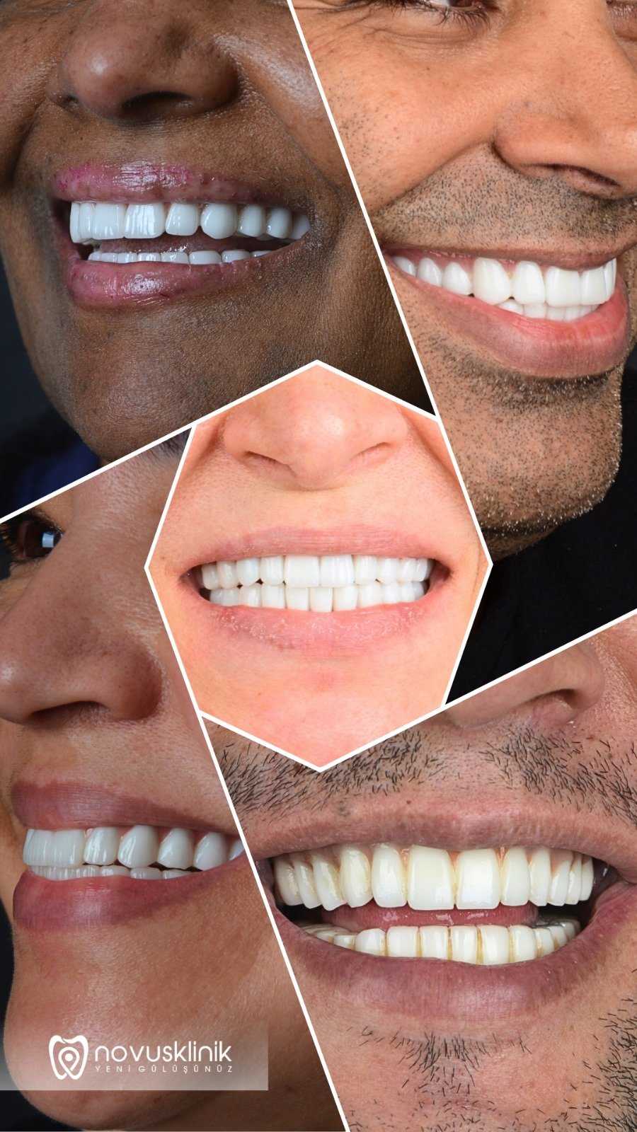 28 X ZIRCONIA CROWNS SMILE DESIGN PACK