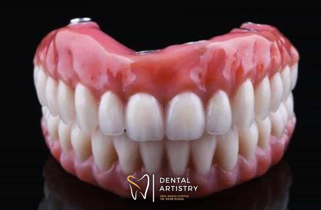 All-Inclusive All-on-6 Dental Implants Package in Nuevo Progreso, Mexico by Dental Artistry