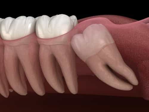 Wisdom Tooth Extraction Package in Nuevo Progresso, Mexico by Dental Artistry & World Dental Center