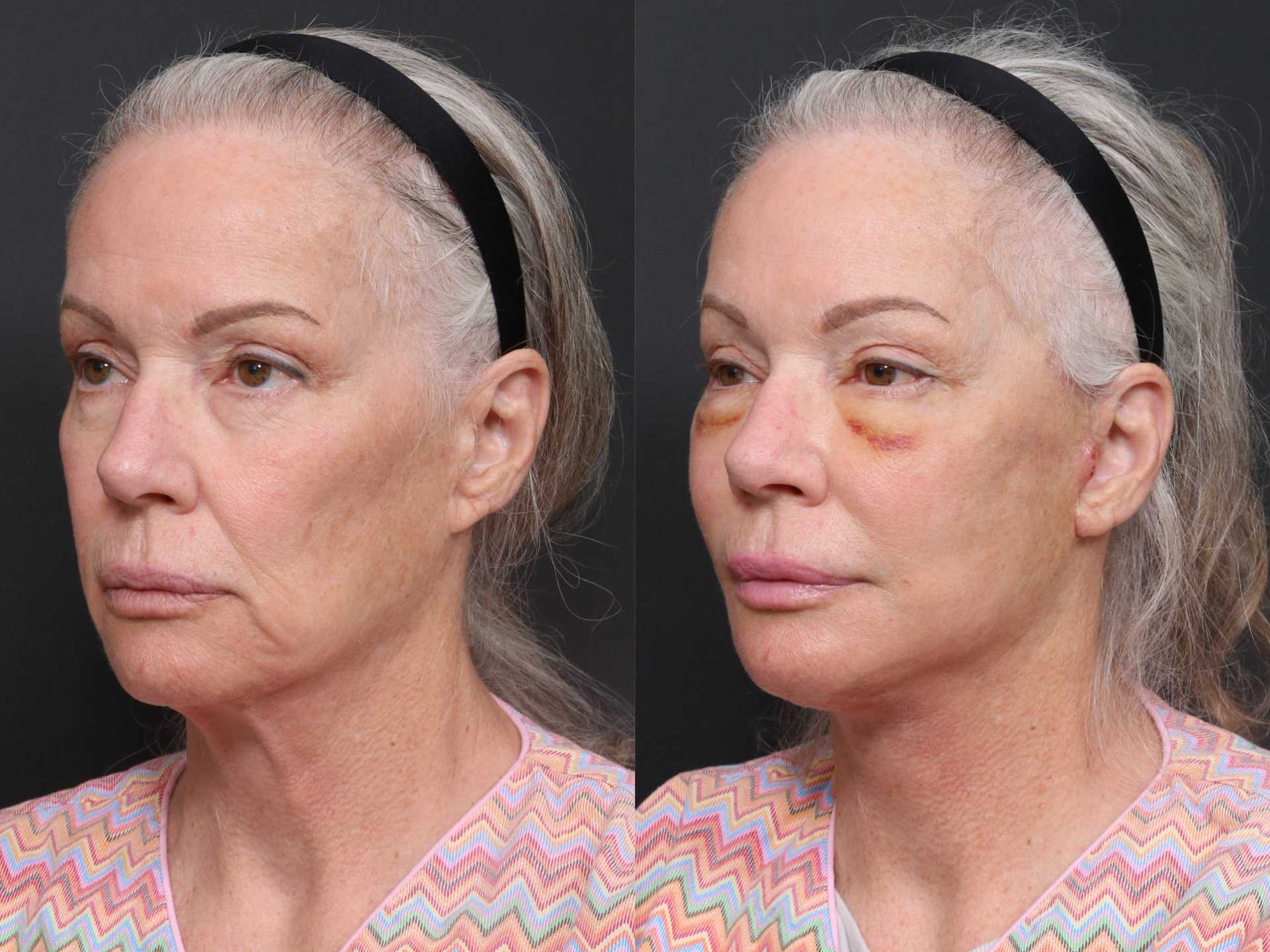 Revision Deep Plane Facelift with Expert Surgeon by Dr. Minhee Ryu at RNWOOD