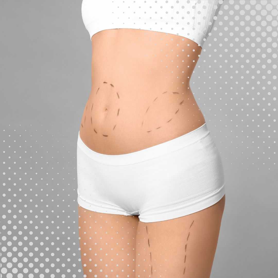 Vaser Liposuction Package in Athens, Greece by Dr. Elias Moustakis