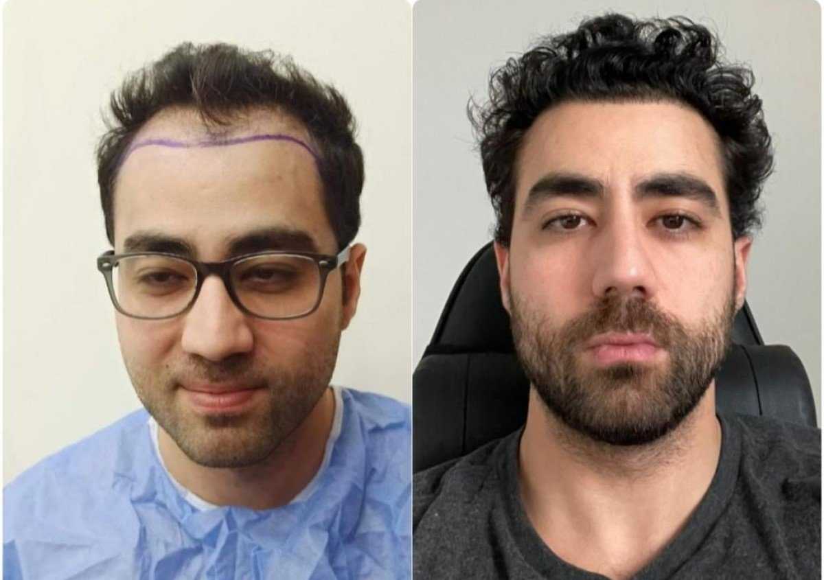 Hair Transplantation