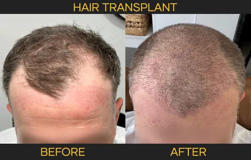 Cocoon's Hair Transplant  (FUE Hair Restoration)