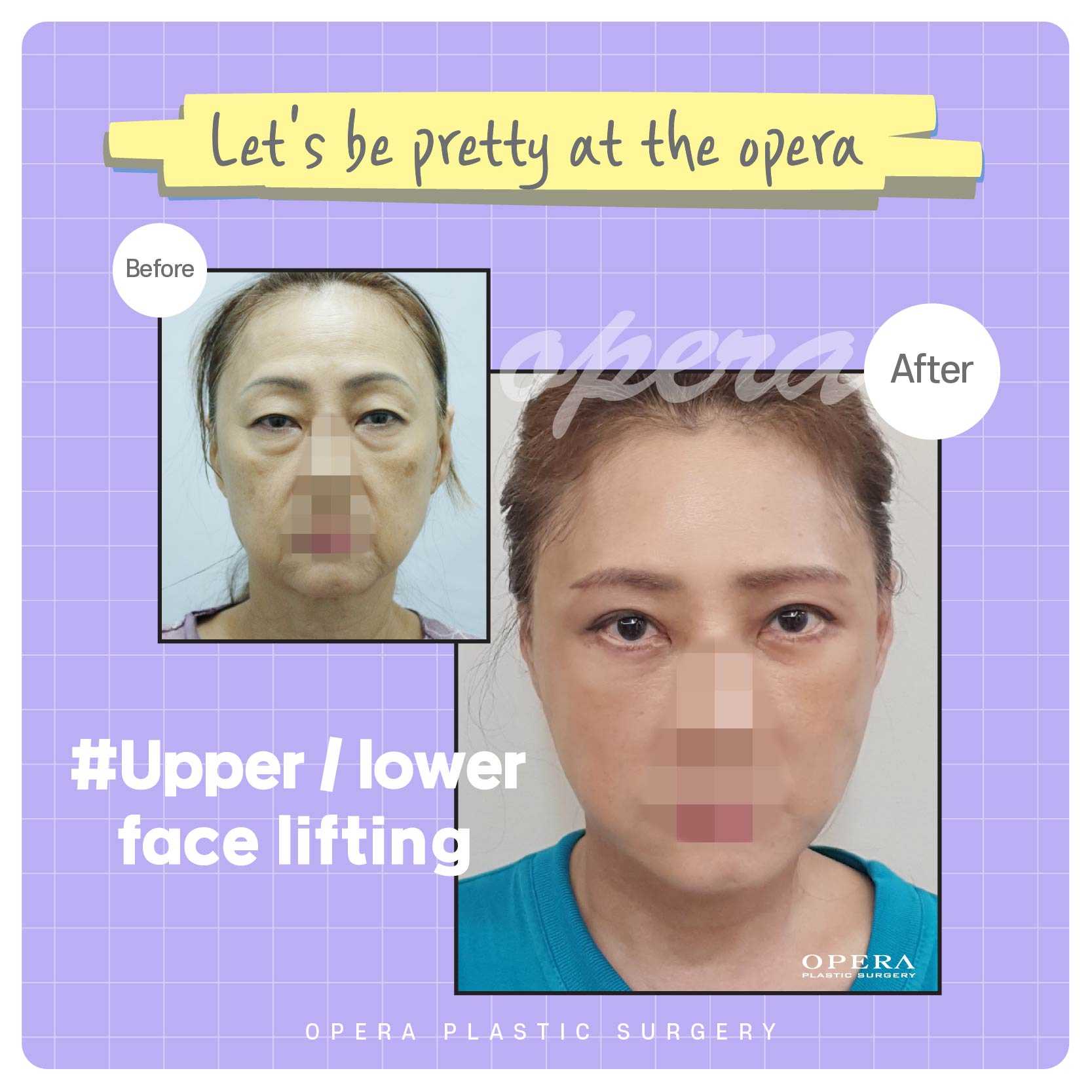 Face Lift Package at Opera Plastic Surgery in Gangnam, South Korea, Seoul, South Korea