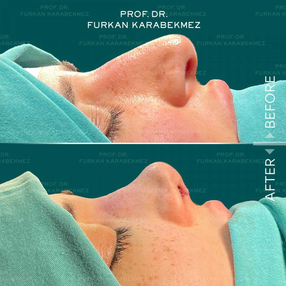 Nose Surgery Rhinoplasty special discount Package at Prof. Dr. Furkan Karabekmez Clinic | Best Plastic Surgery Ankara, ankara, Turkey