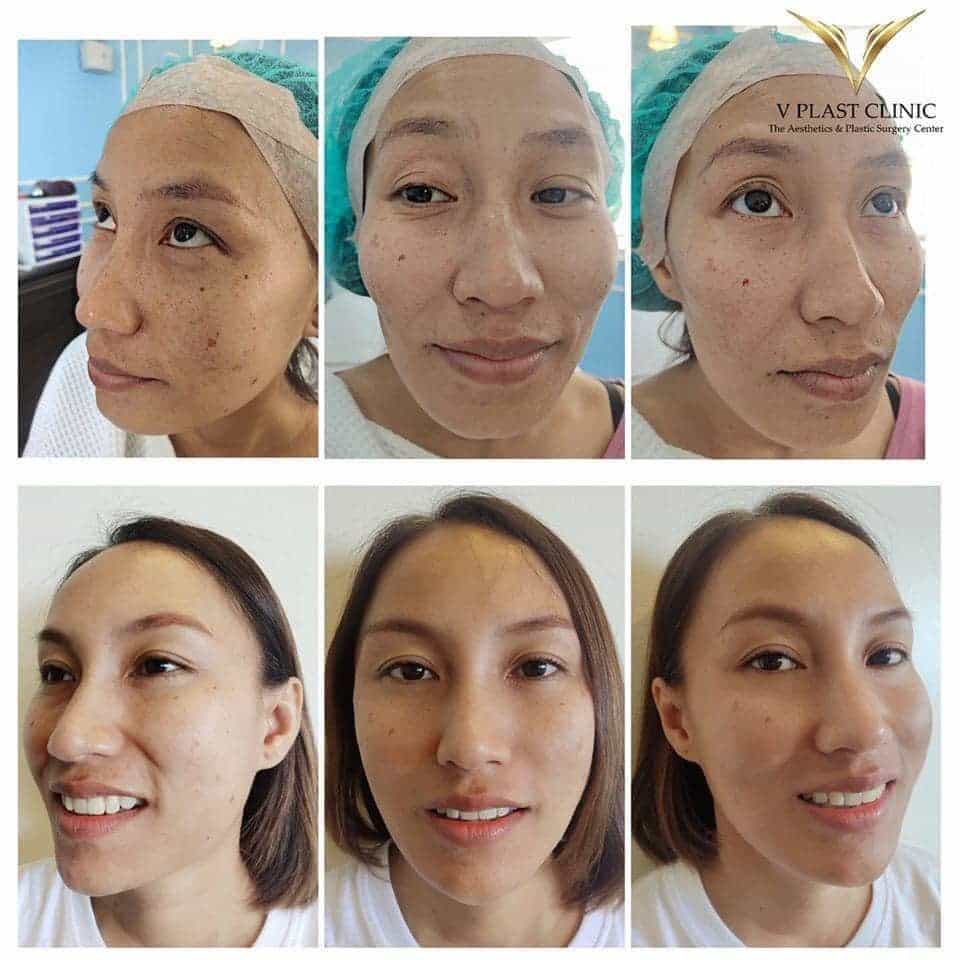 V Plast Clinic - The Aesthetic and Plastic Surgery Center