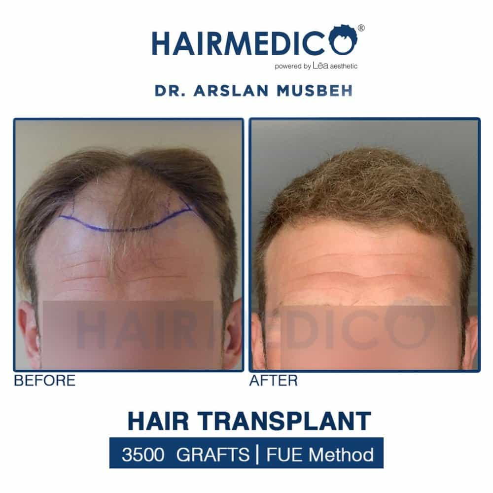 Hairmedico