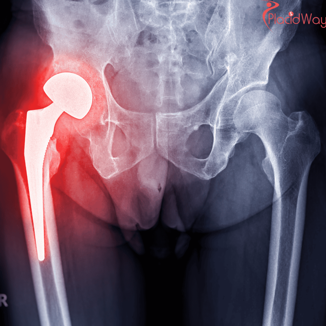 What is the Cost of Total Hip Replacement Surgery in India?