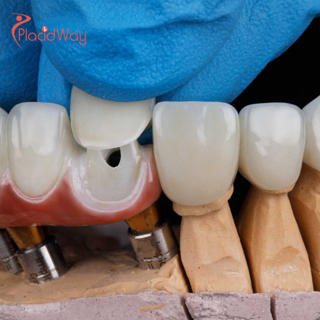 How Affordable are Dental Crowns in Croatia?
