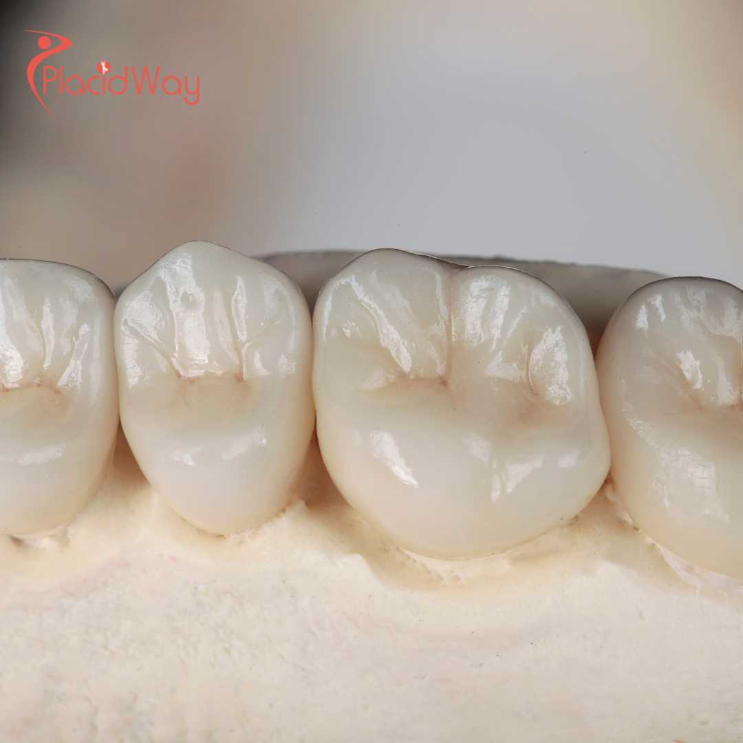 Why Are Dental Crowns in Vietnam so Popular?