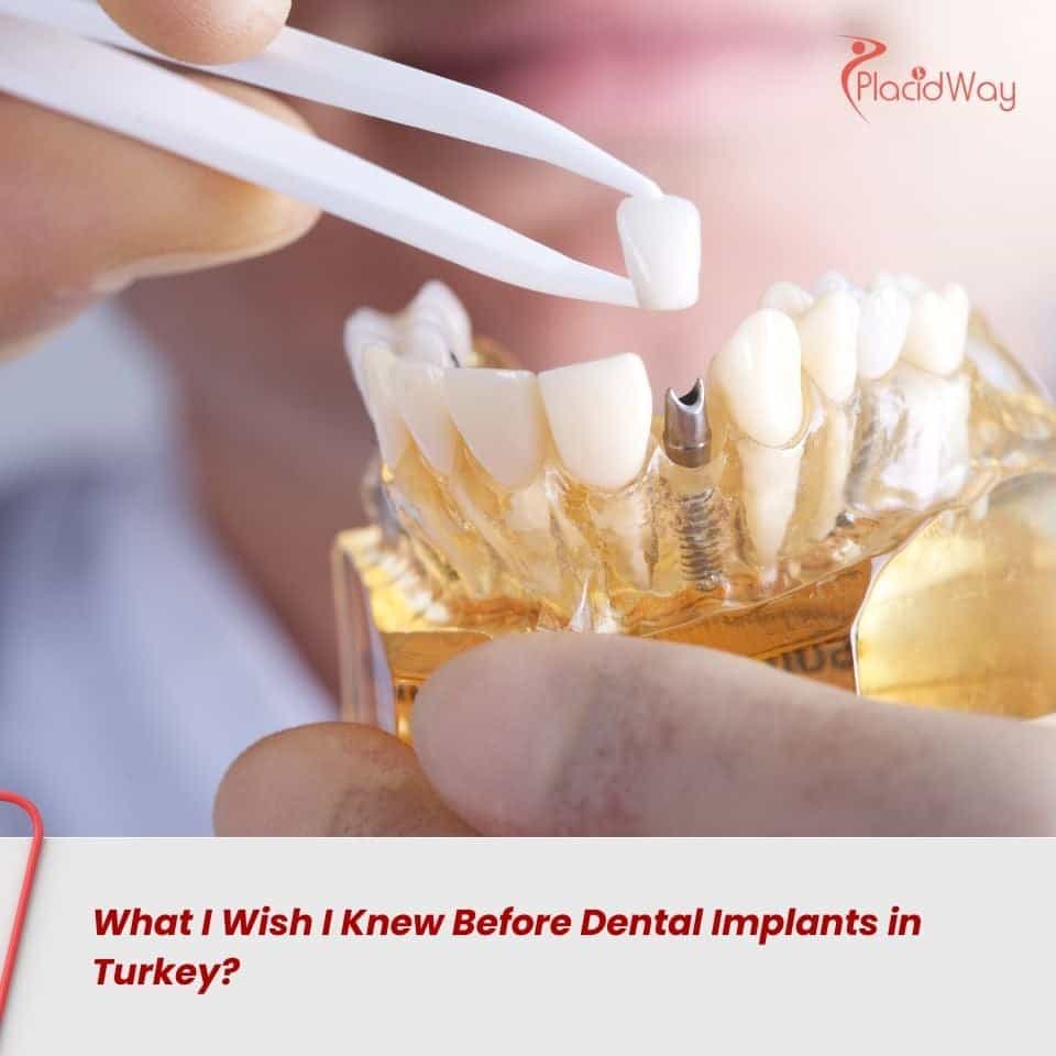 What I Wish I Knew Before Dental Implants in Turkey?