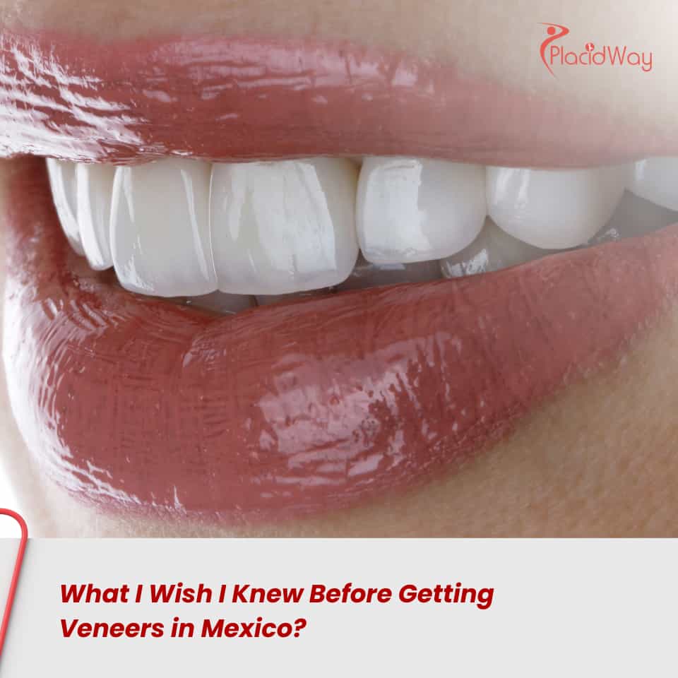 What I Wish I Knew Before Getting Veneers in Mexico?