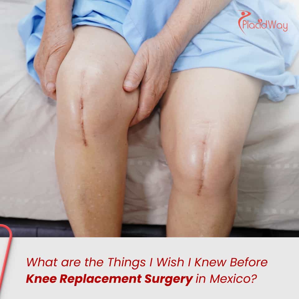 What are the Things I Wish I Knew Before Knee Replacement Surgery in Mexico?
