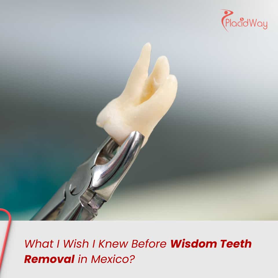 What I Wish I Knew Before Wisdom Teeth Removal in Mexico?