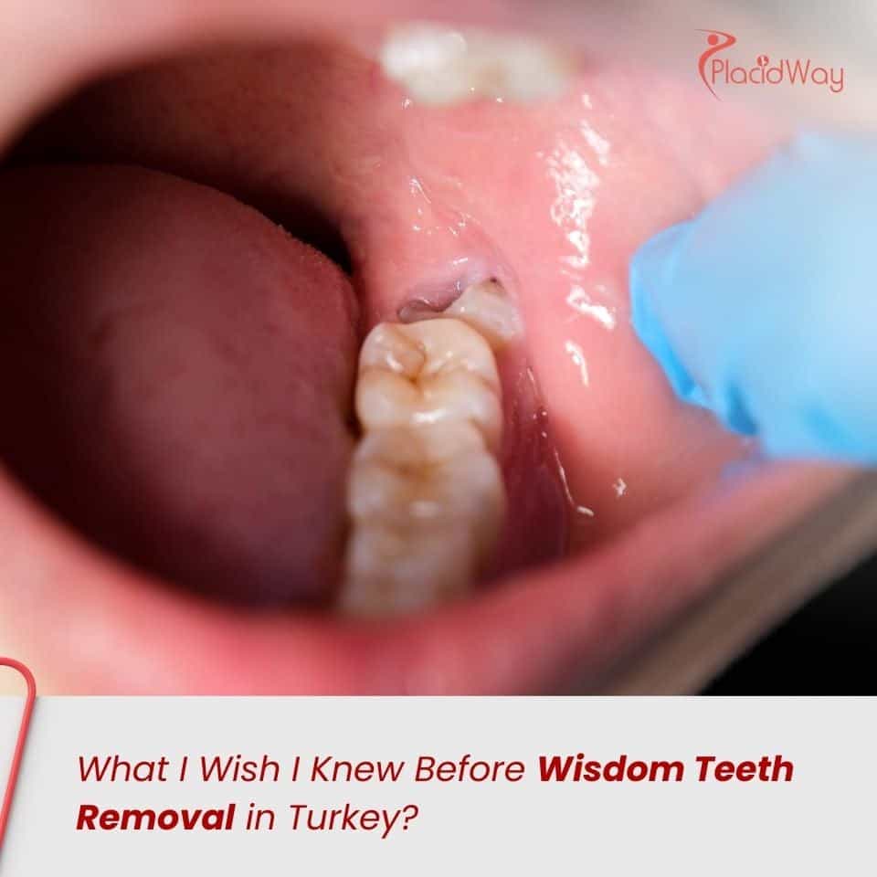 What I Wish I Knew Before Wisdom Teeth Removal in Turkey?