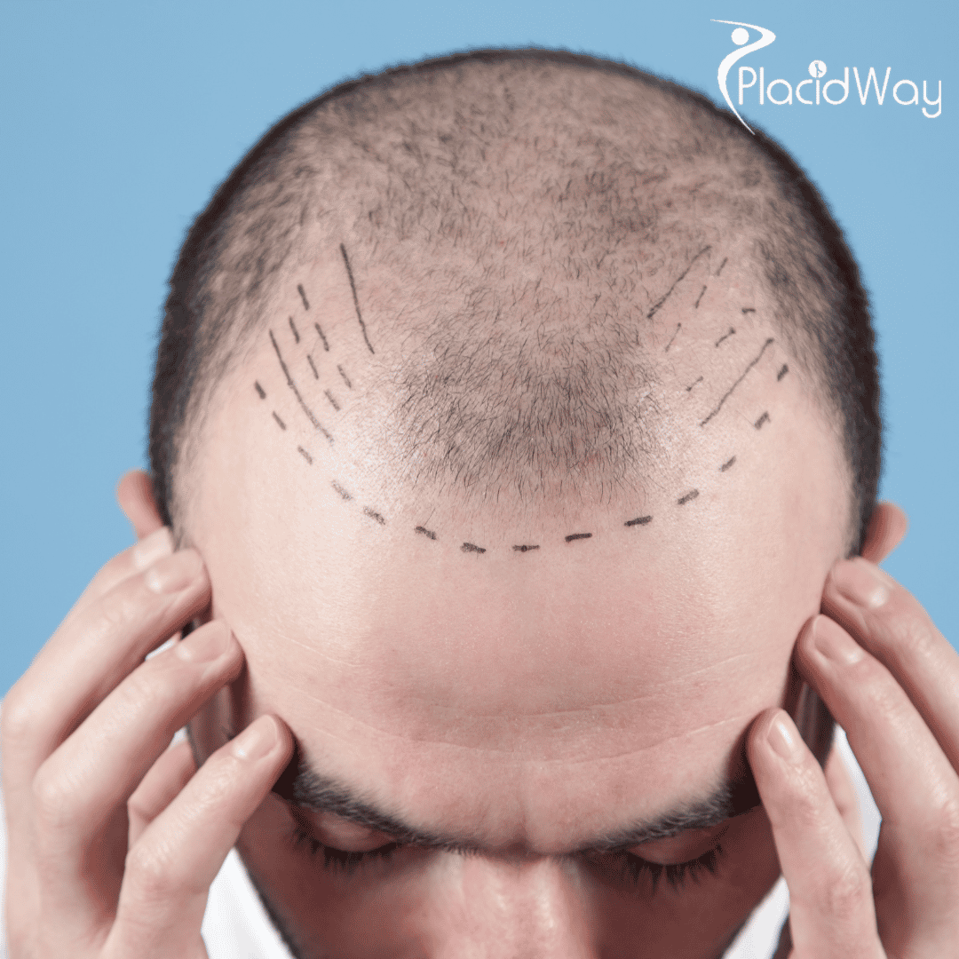  Why Are Turkey Hair Doctors Renowned for Their Expertise in Hair Loss Treatment?