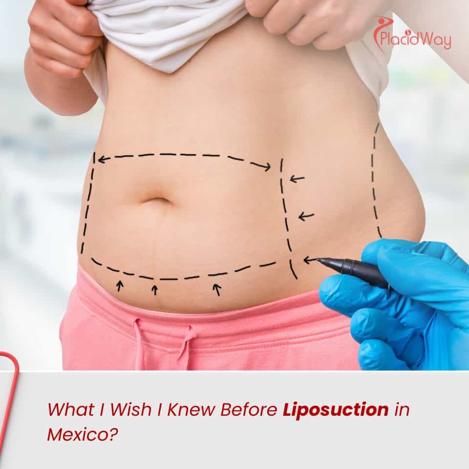 What I Wish I Knew Before Liposuction in Mexico?