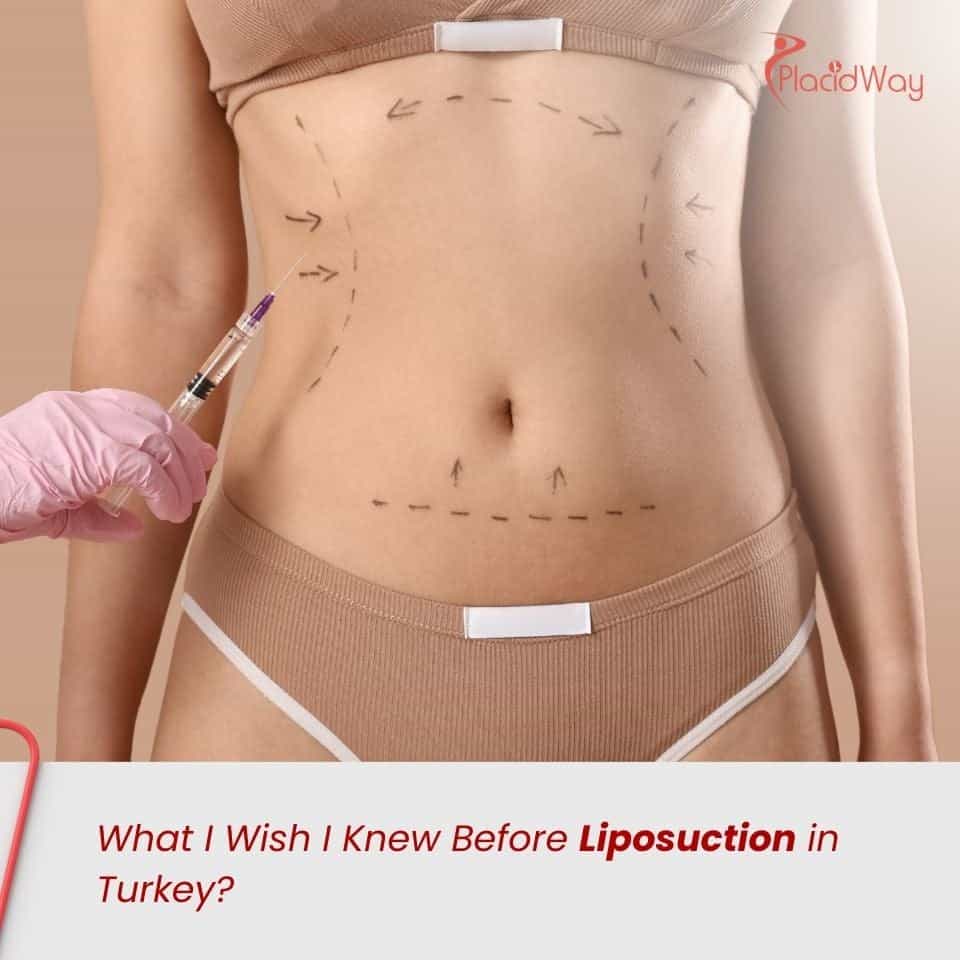 What I Wish I Knew Before Liposuction in Turkey?