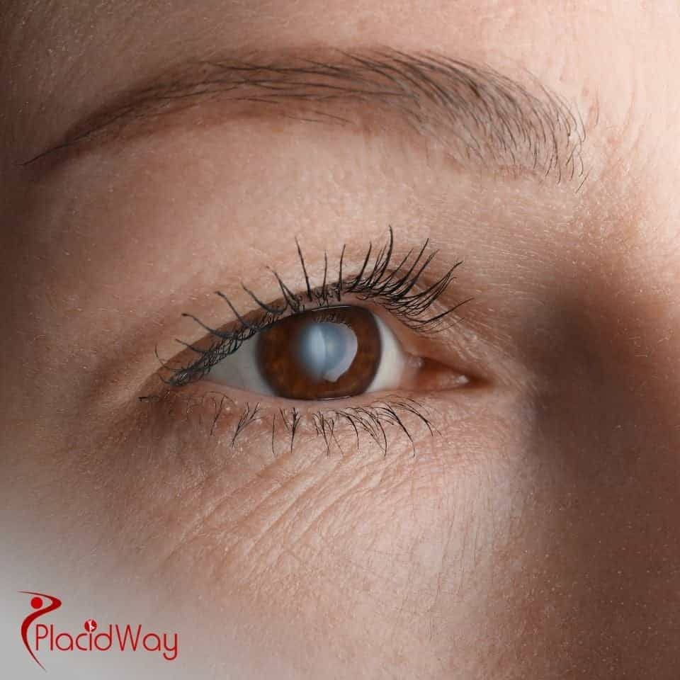 Which hospitals offer affordable cataract surgery in Mexico?