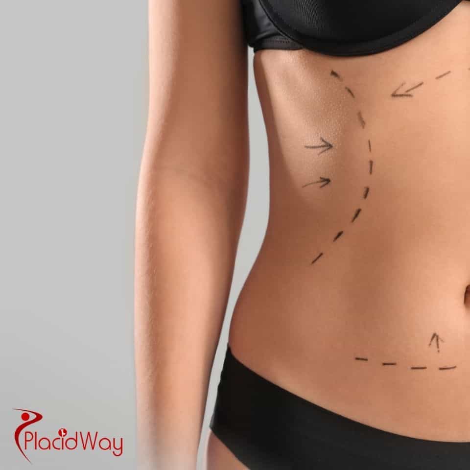 What is the price of full body liposuction in Korea?