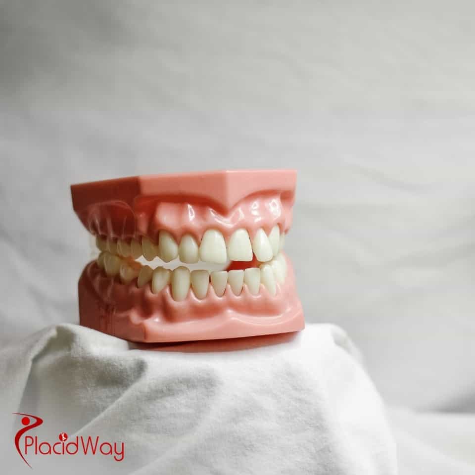 Where Can Patients Get Affordable Dental Crowns In Los Algodones, Mexico?