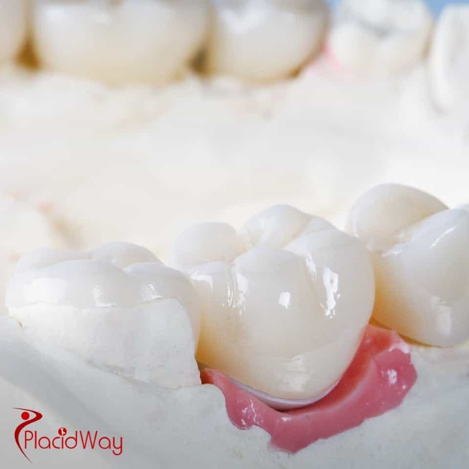 Which Is The Cheapest Country For Dental Work Including Crowns And Veneers?