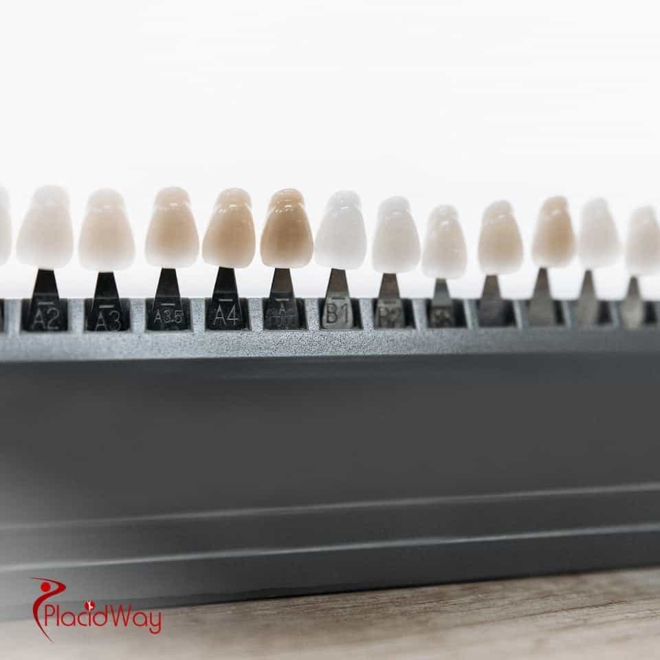 What Is The Current Cost Of Veneers In Cancun Compared To Other Mexican Cities?