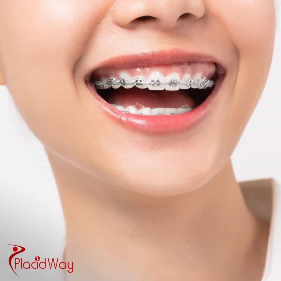 What Is The Cost Of Braces In Mexico Compared To The U.S.?