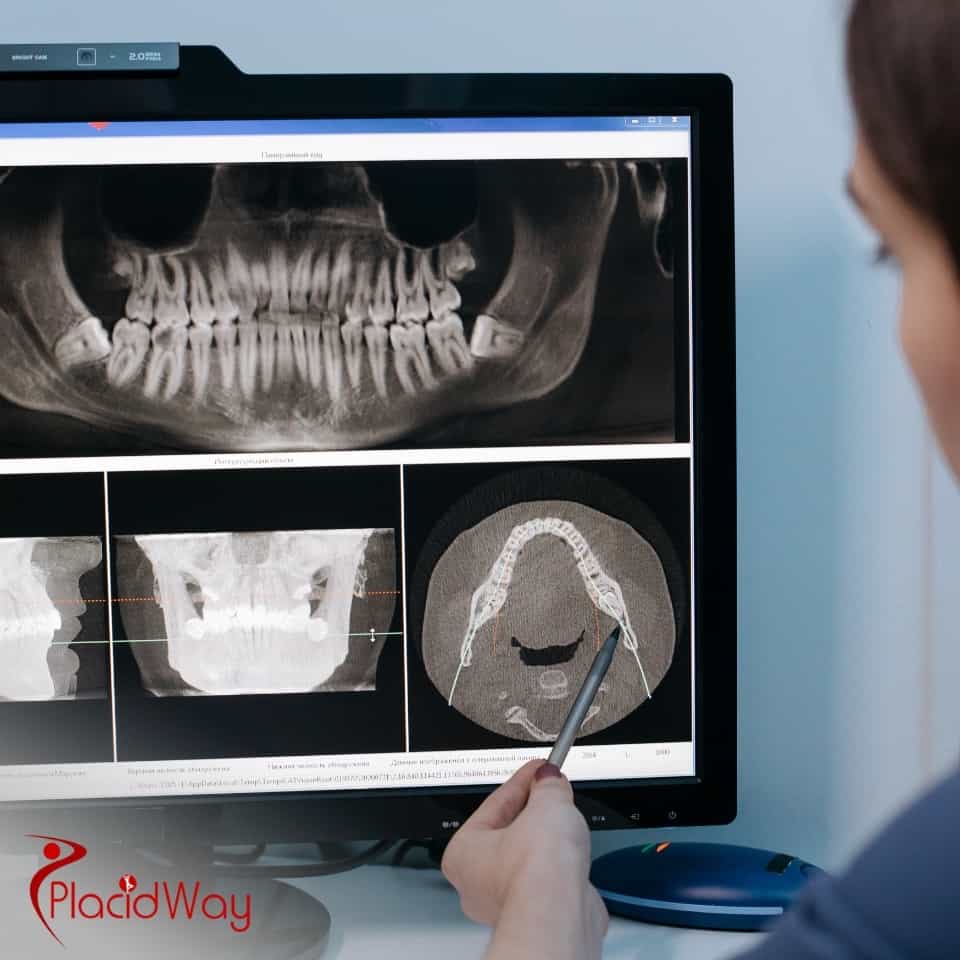 Are Dental Implant Packages Abroad Worth It?