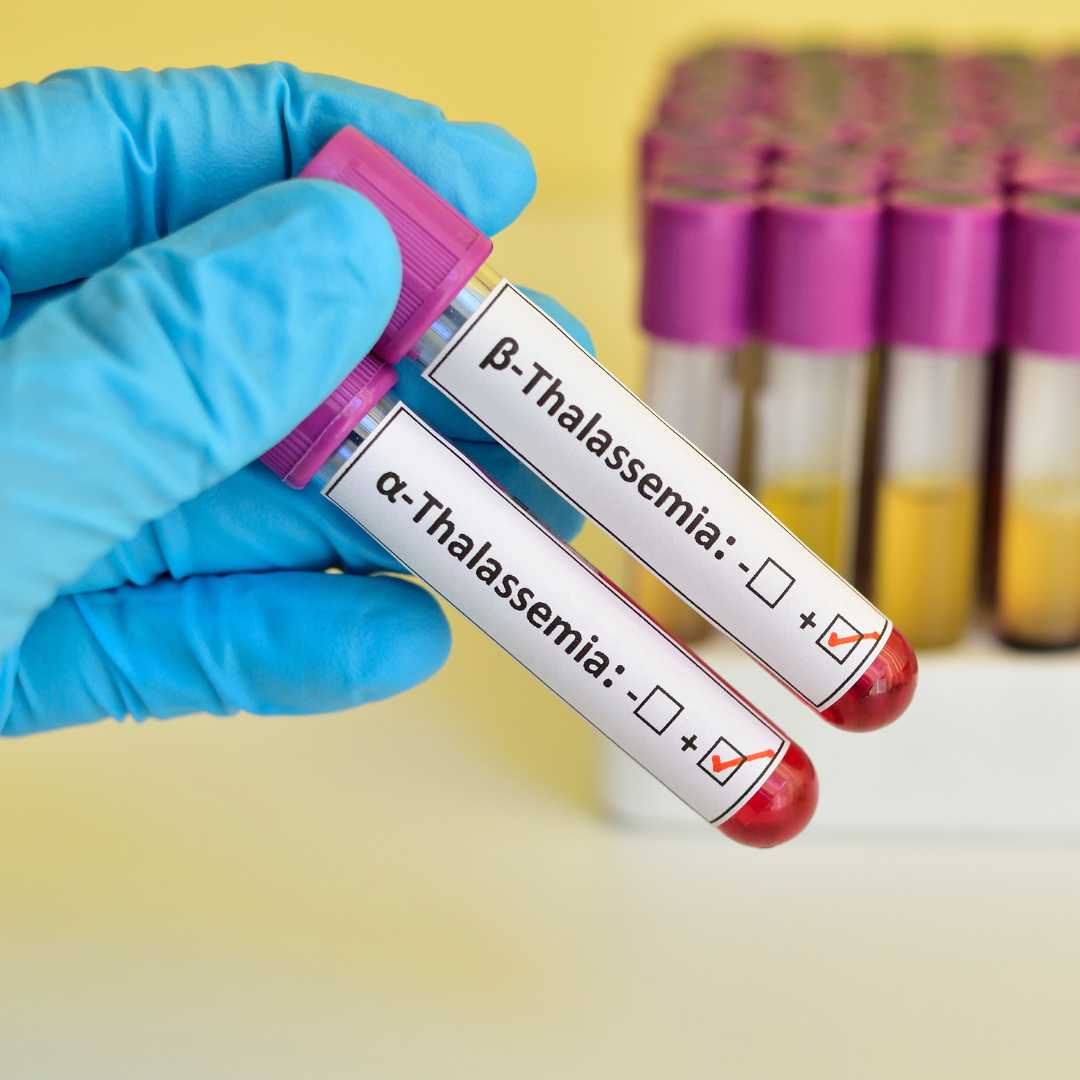 What is the New Treatment for Thalassemia 2025?