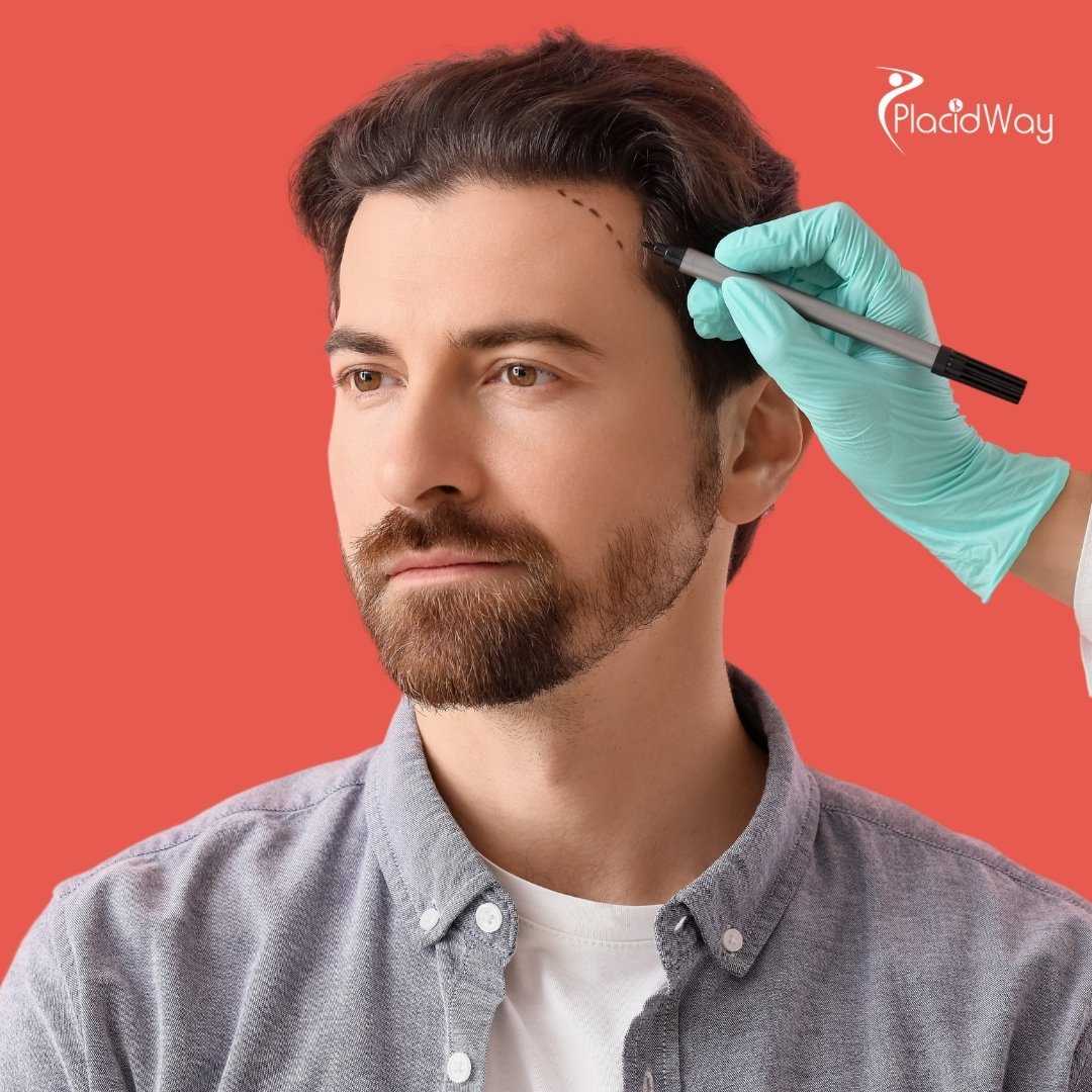 Is it safe to get a hair transplant in Mexico?