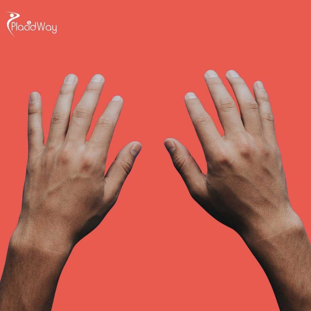 Where Can I Find Specialists for Hand Surgery in Tijuana?